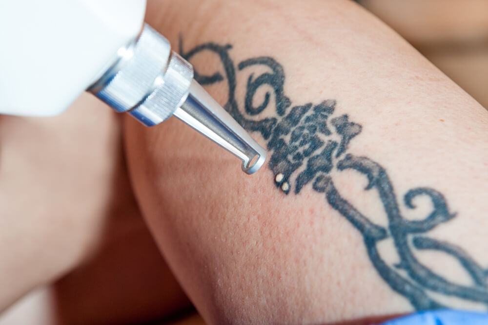 Na czym polega laserowe usuwanie tatuażu?
